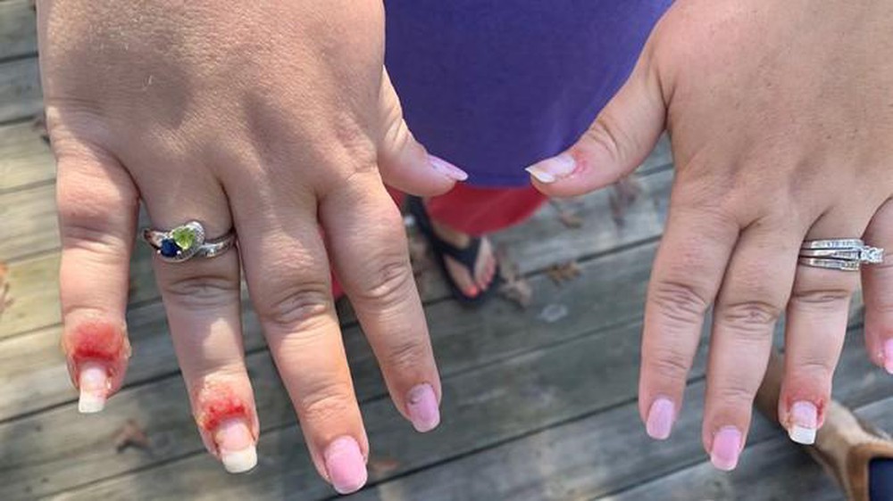 consequences of nail allergy