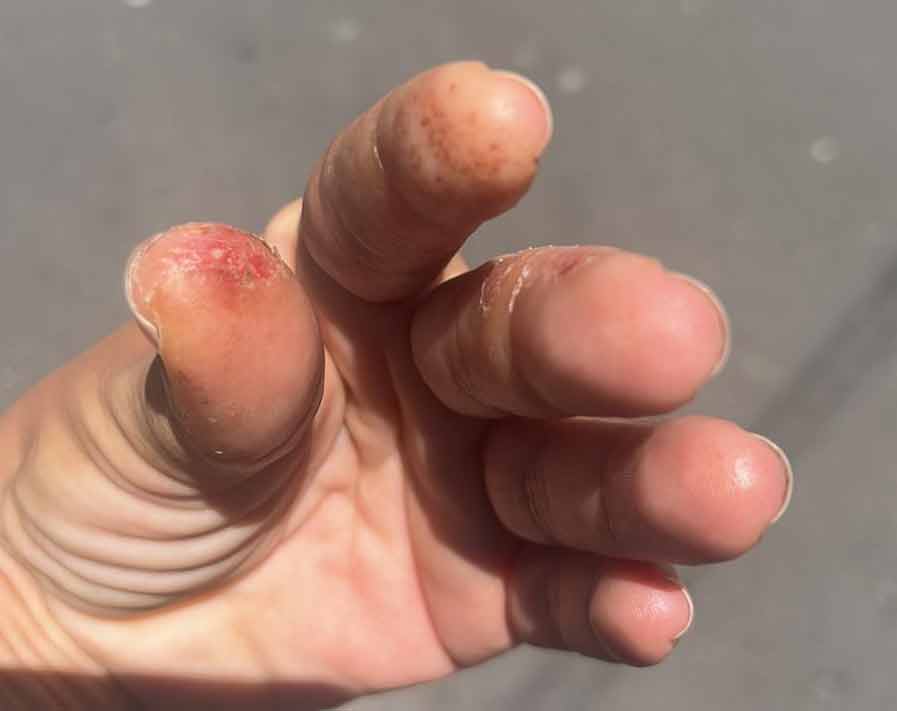 dolor picor escozor en los dedos por alergia a los esmaltes semipermanentes